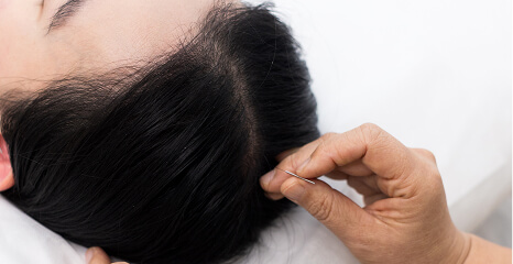 Scalp acupuncture